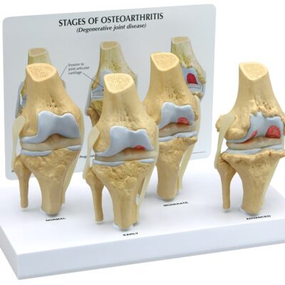 4-Stage Osteoarthritis Knee Model with Base
